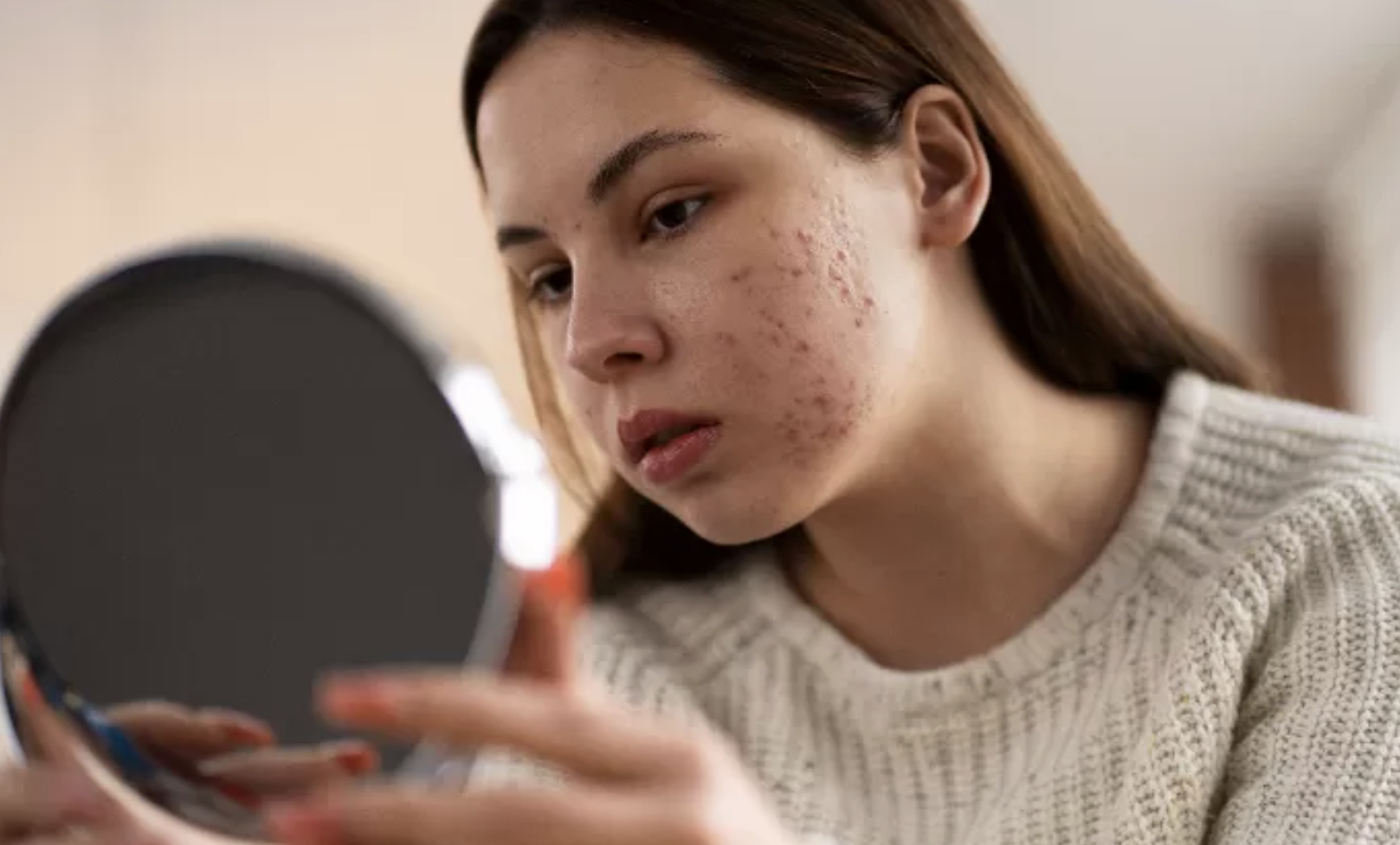 Perempuan dengan kulit berjerawat. (Freepik)