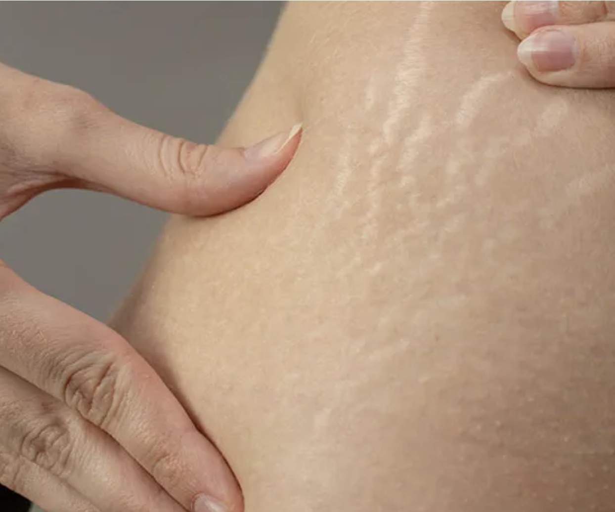 Ilustrasi stretch mark. (HALODOK.COM)