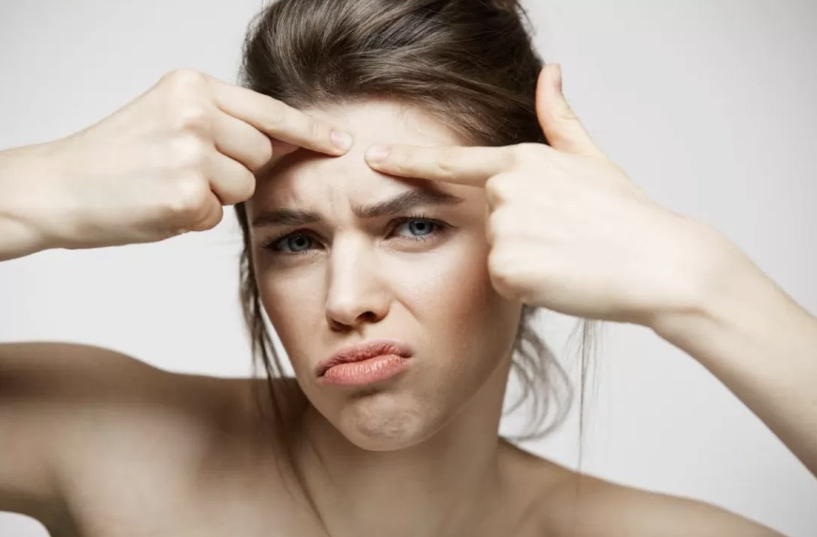 Ada banyak penyebab brutusan di jidat. Salah satunya adalah karena pola makan yang tidak sehat. (Cookie_studio/Freepik)