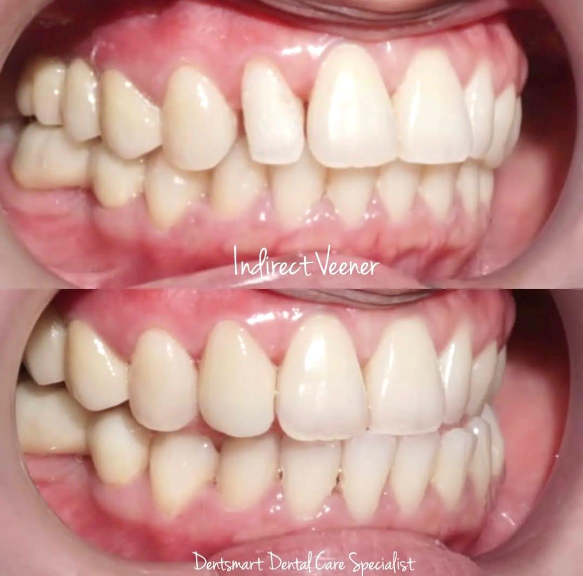 Salah satu hasil veneer indirect di Klinik Gigi, Dentsmart Dental Care Specialist Berau. (DENTSMART DENTAL CARE SPECIALIST BERAU UNTUK BERAU POST)
