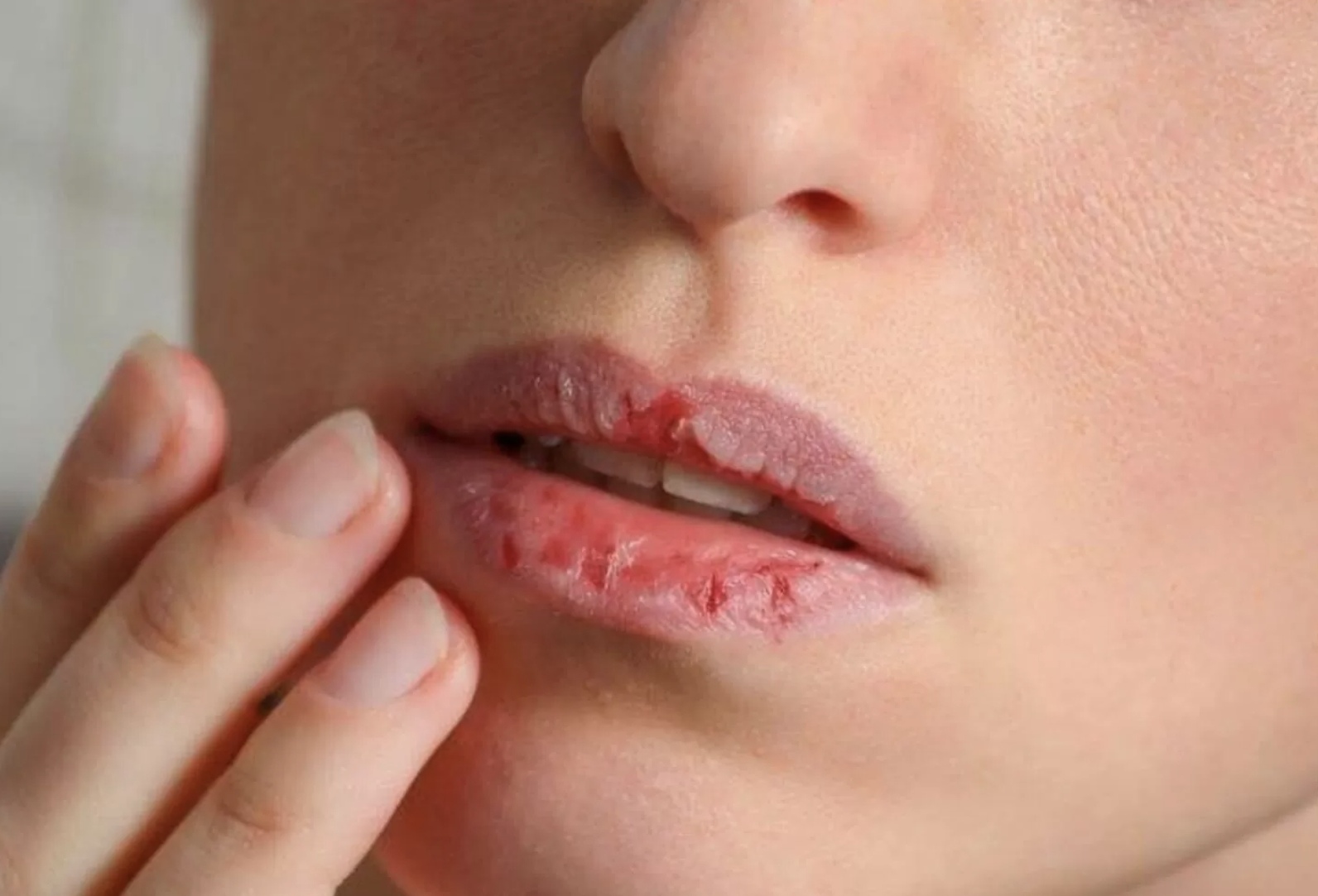 Ilustrasi bibir kering. (Freepik)