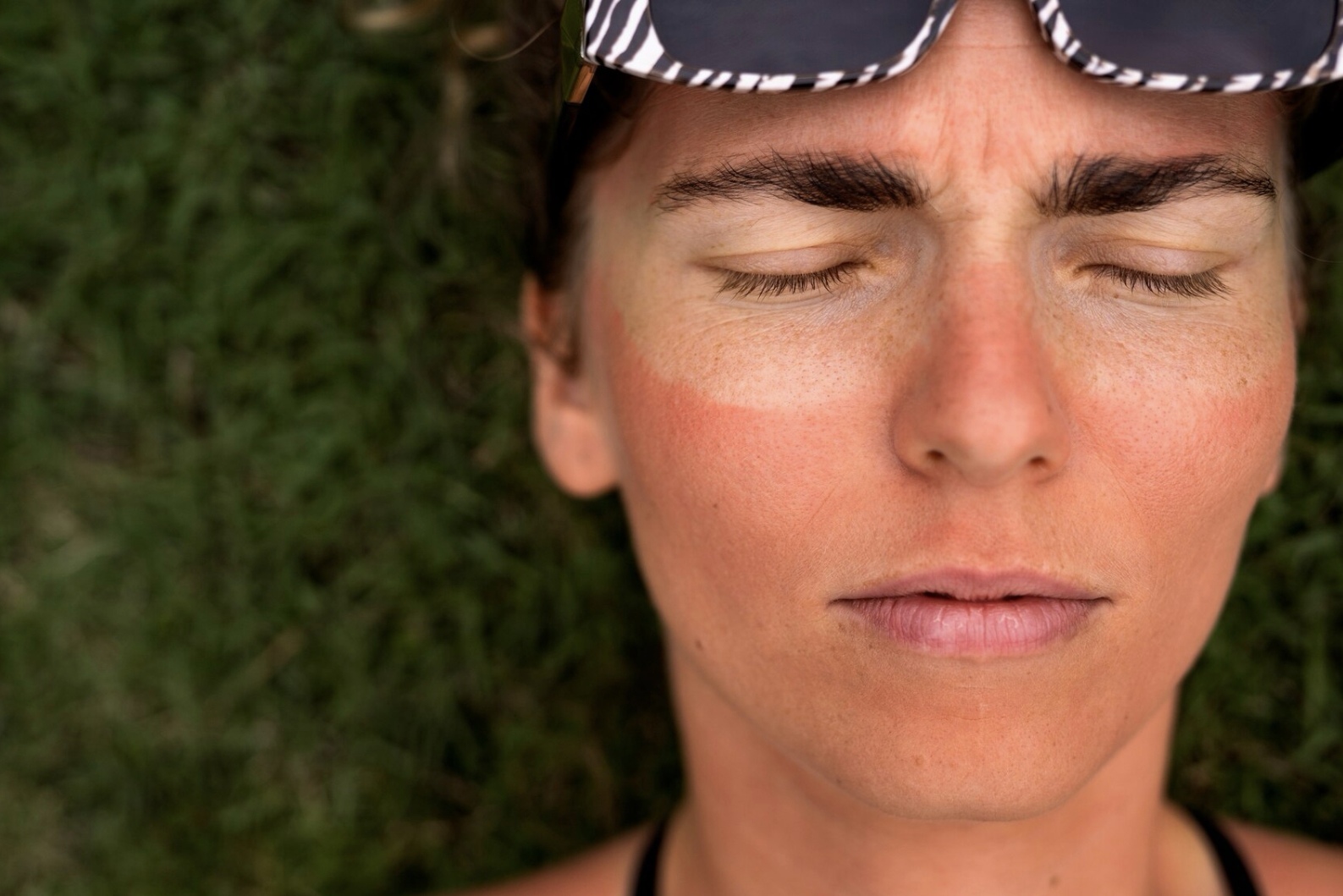 Ilustrasi sunburn. (Freepik)