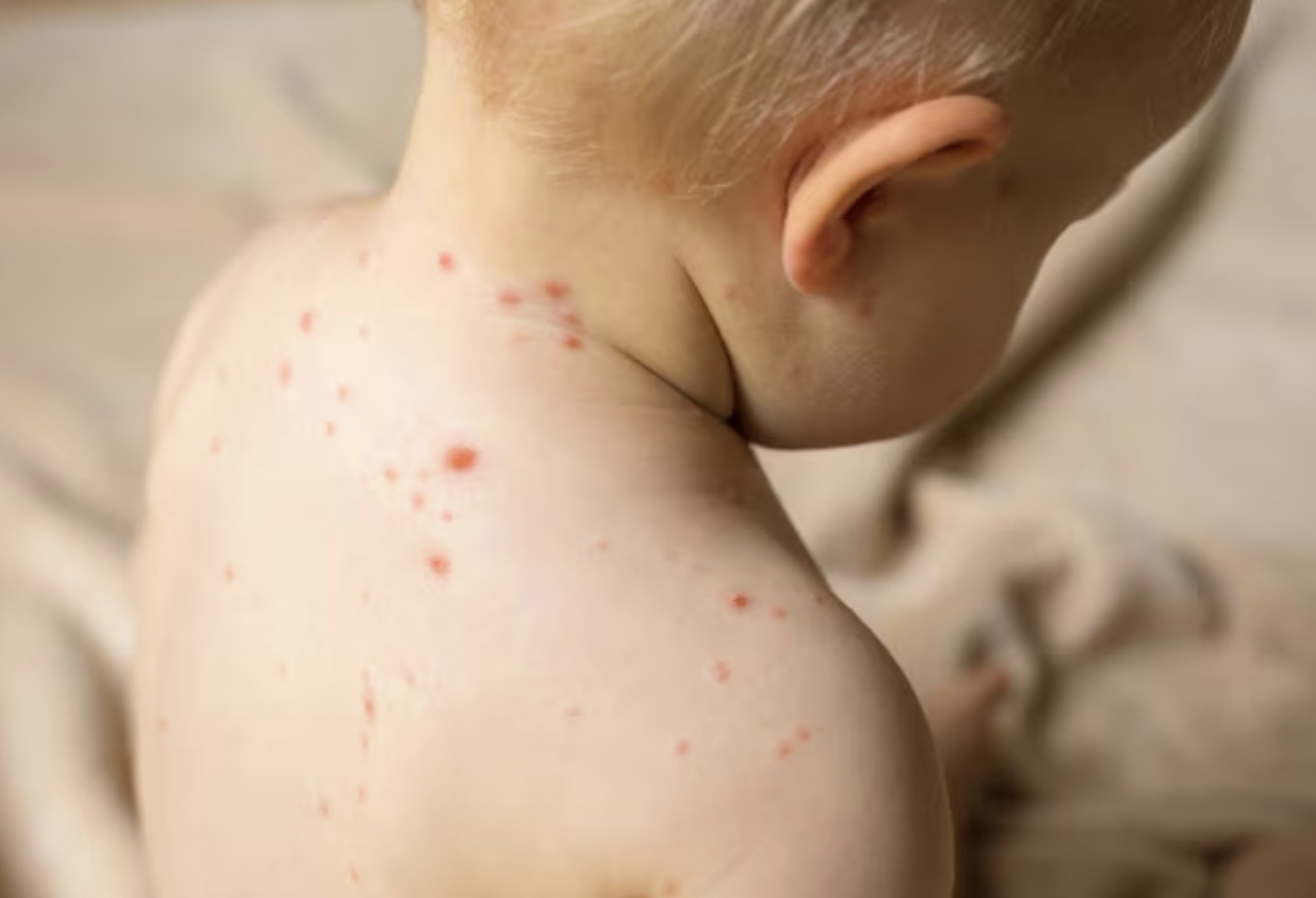 Ilustrasi anak terkena cacar. (Freepik)