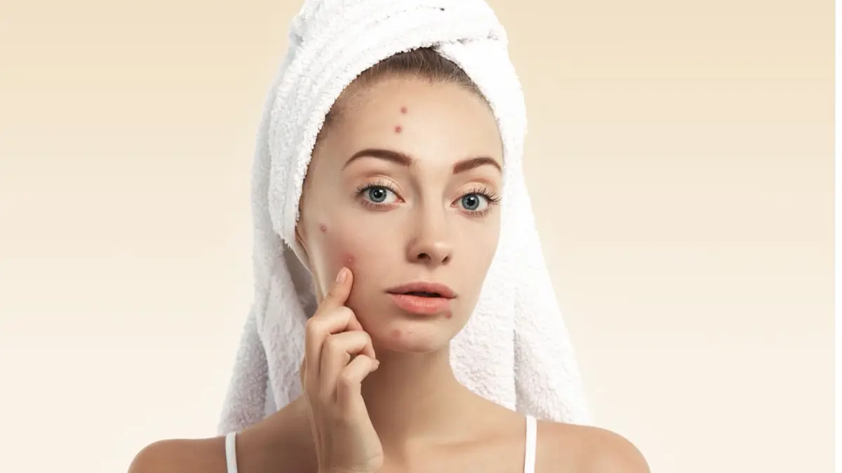 Ilustrasi pencet jerawat. (Freepik)