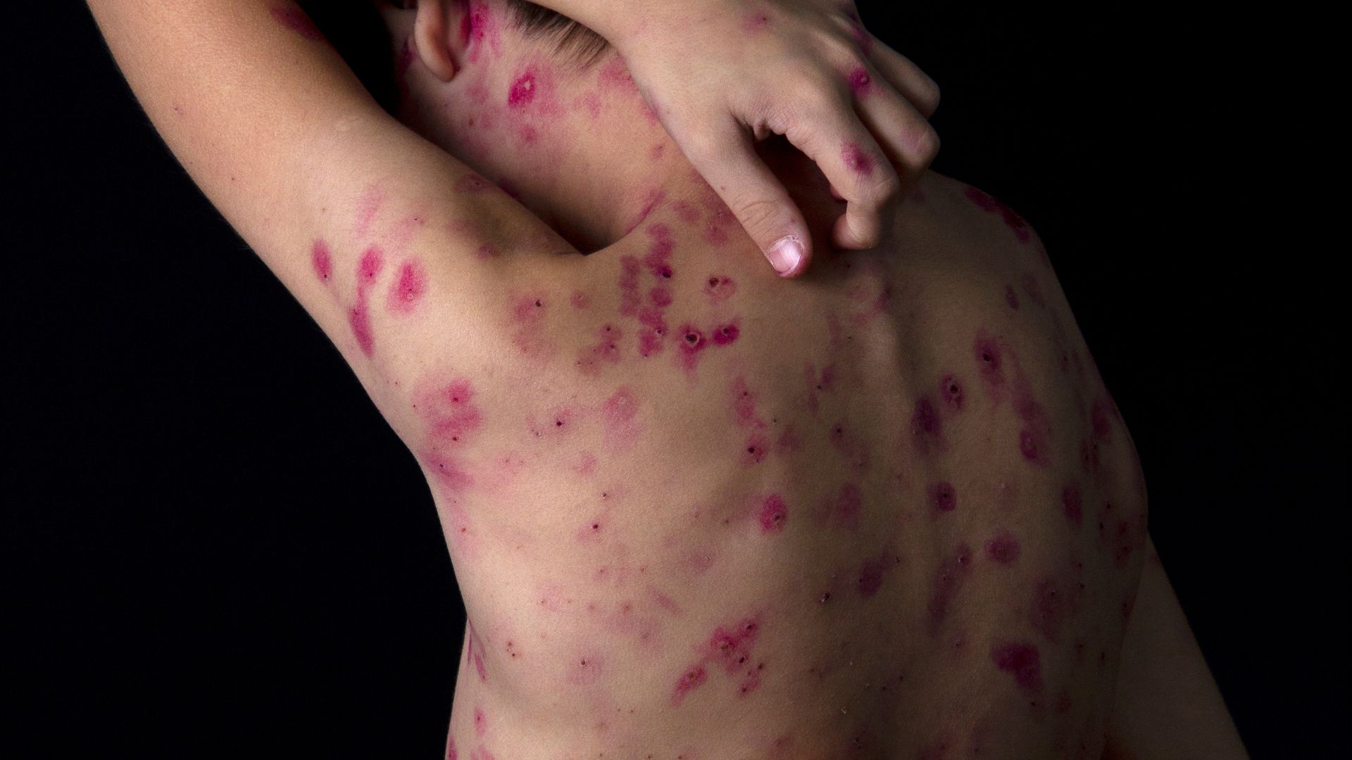 Ilustrasi penyakit kudis (canva.com)