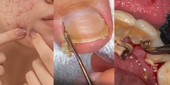 Pimple popping, pedicure, dan scaling