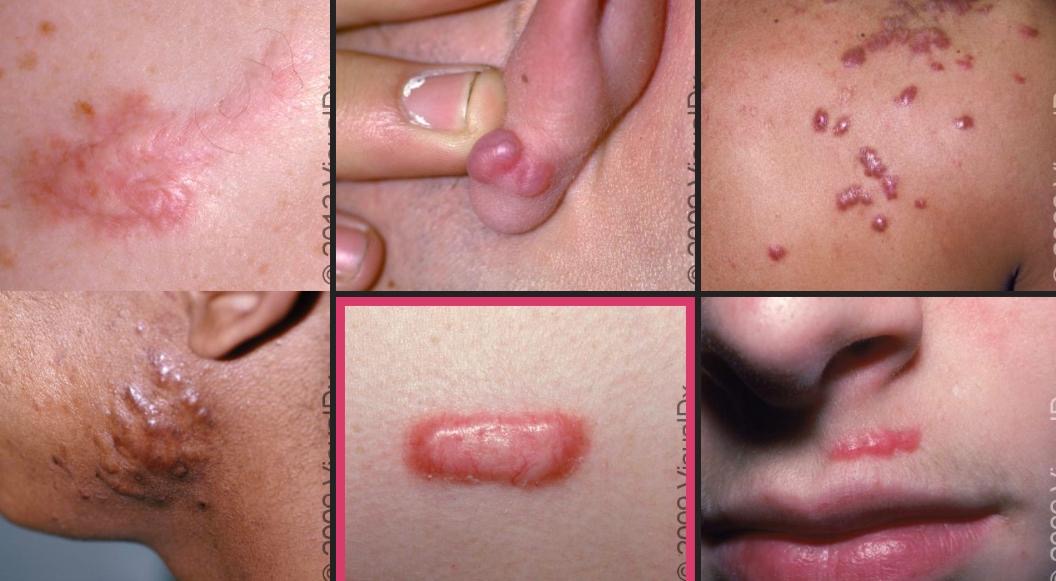 Penyebab dan Cara Mengatasi Keloid yang Mengganggu Penampilan Kulit, Ini Kata Dokter