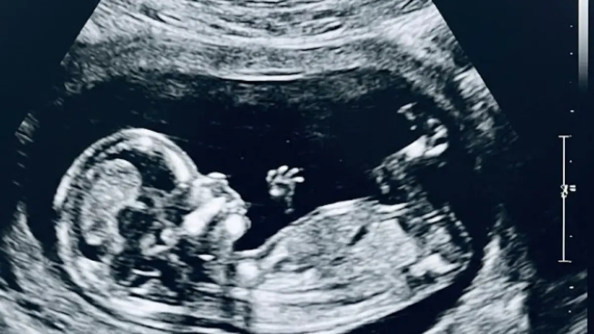 Ilustrasi hasil pemindaian medis berupa foto USG (Ultrasonografi) kehamilan.