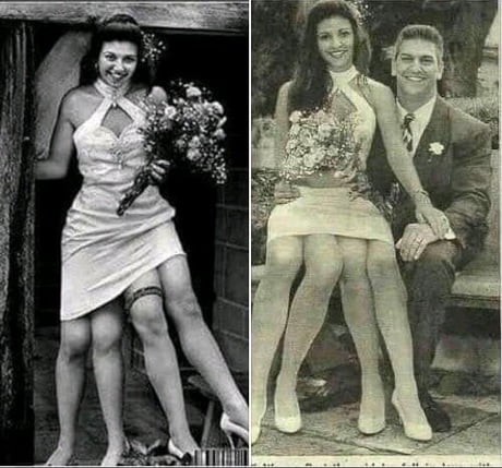 Myrtle Corbin, si cantik berkaki empat dan dua rahim, temukan cinta sejati di usia 19 tahun. (istimewa)