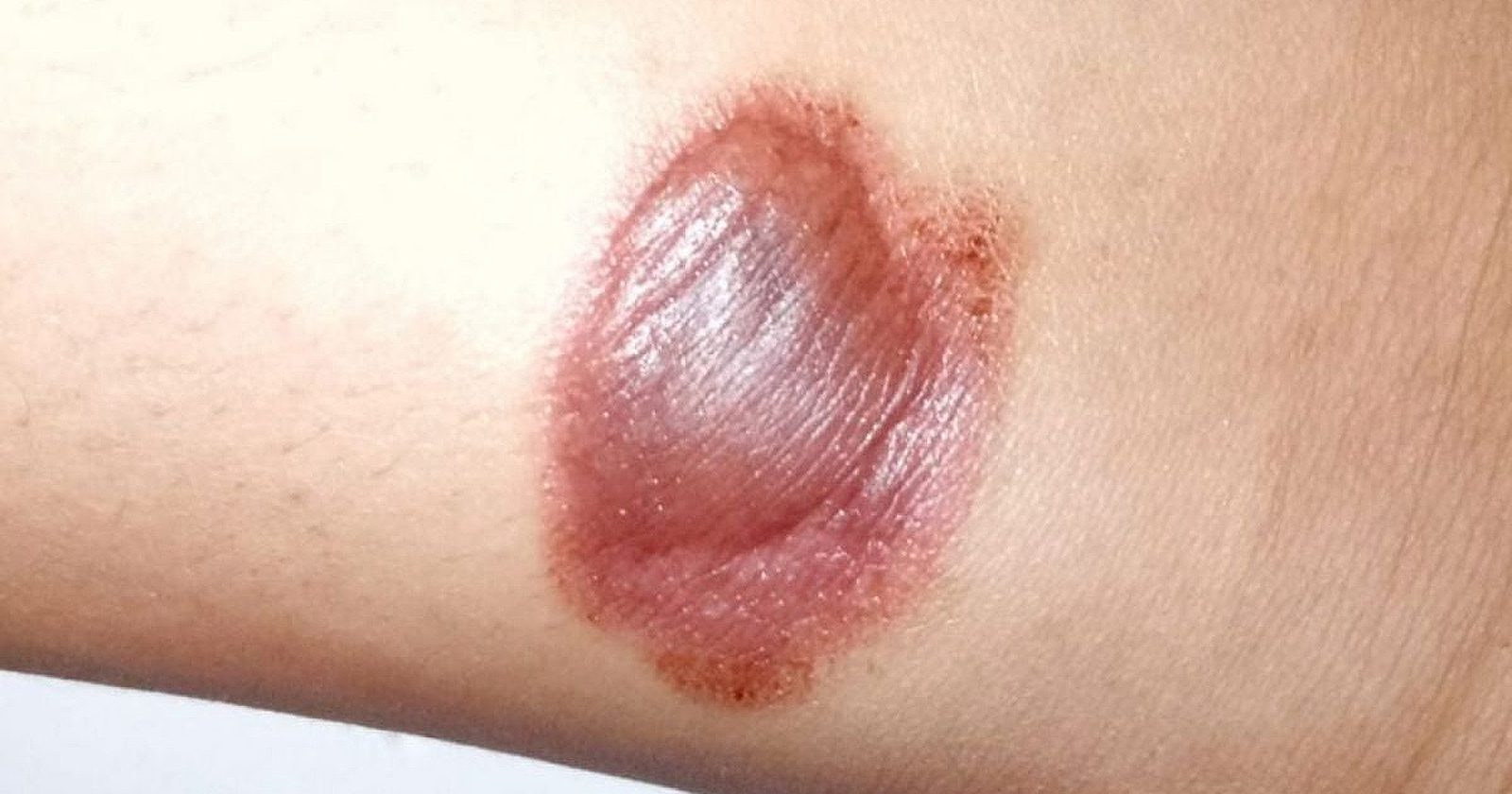 Ilustrasi luka bakar