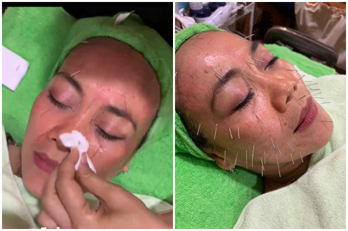 Treatment akupuntur di Eva Salon dan Spa