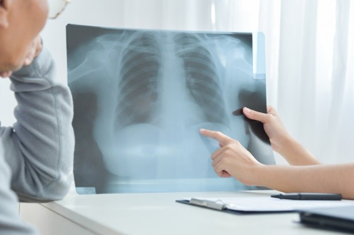 Ilustrasi penyakit pneumonia