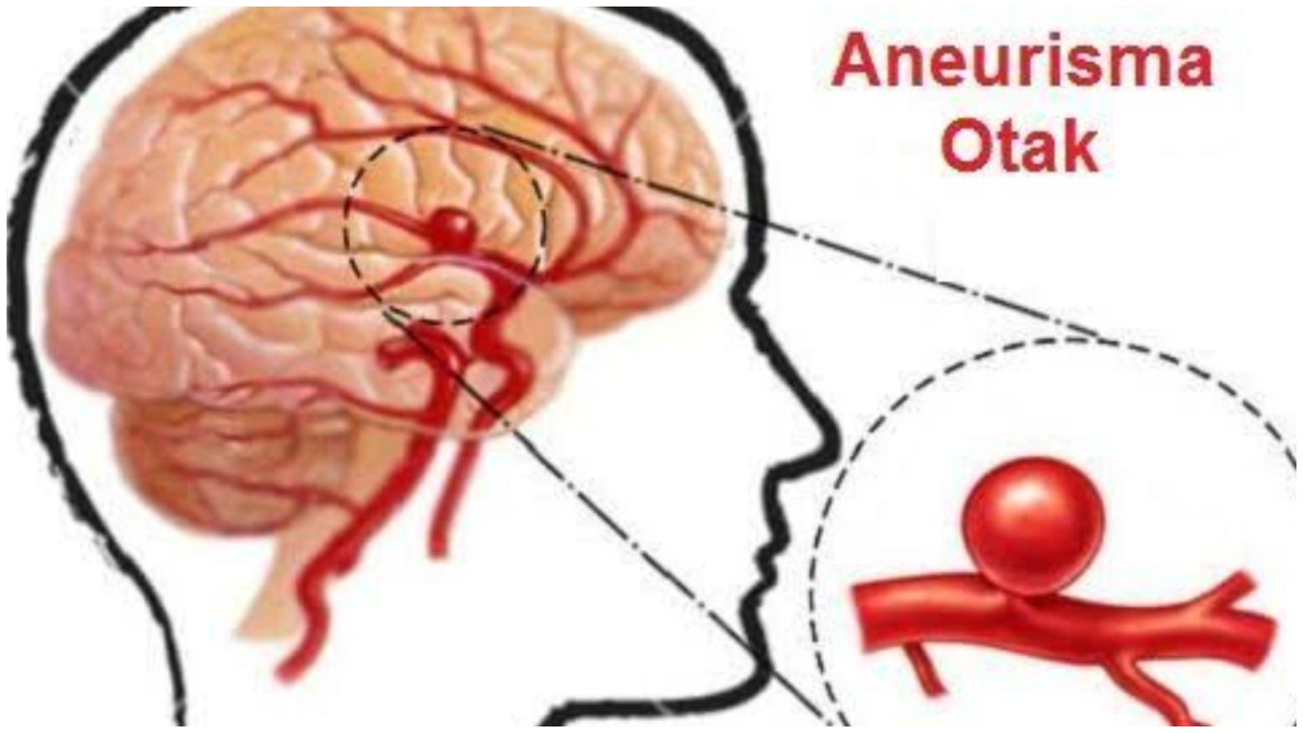 Ilustrasi Aneurisma Otak