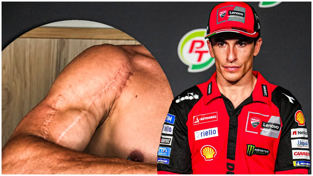 Pembalap Ducati Lenovo Team Marc Marquez bersiap kembali di MotoGP Italia. Tampak bekas operais di lengannya.