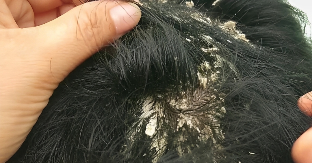Ketombe bisa mengganggu penampilan, simak tips efektif mengatasi ketombe pada rambut di BalikpapanTv.id!