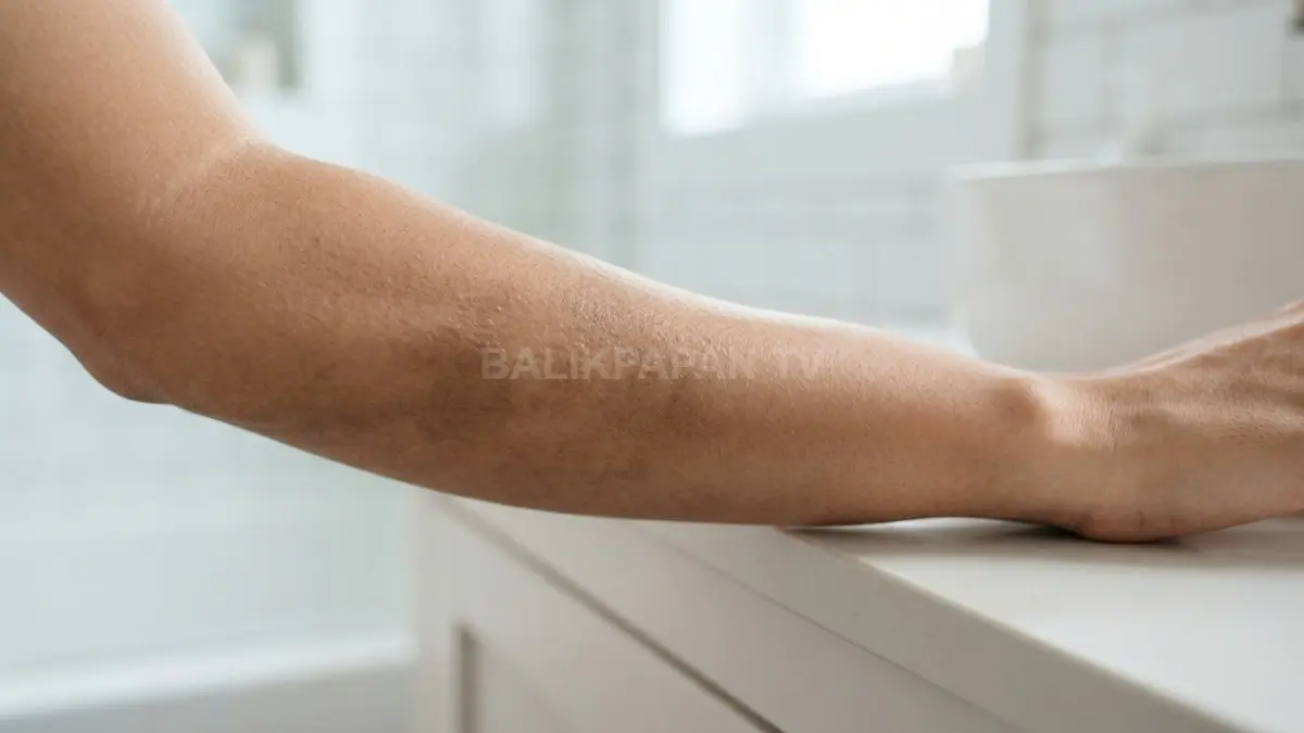 Iritasi berulang memicu produksi melanin berlebih, menyebabkan kulit menjadi gelap dan tidak merata. (BTV/Ai)