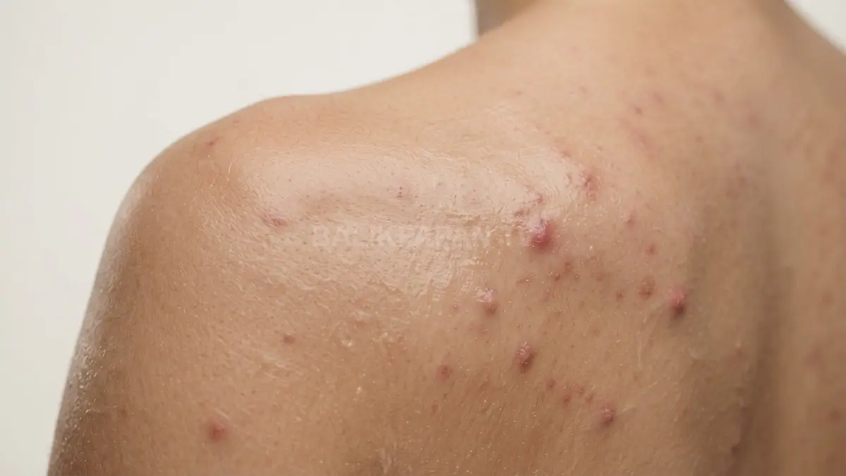 Penumpukan lotion dan minyak berpotensi menyumbat pori-pori hingga memicu jerawat punggung serta folikulitis. (BTV/Ai)