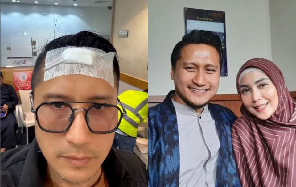 Arie Untung mengalami cedera di jidat saat menjalankan umrah bersama istri. INSTAGRAM