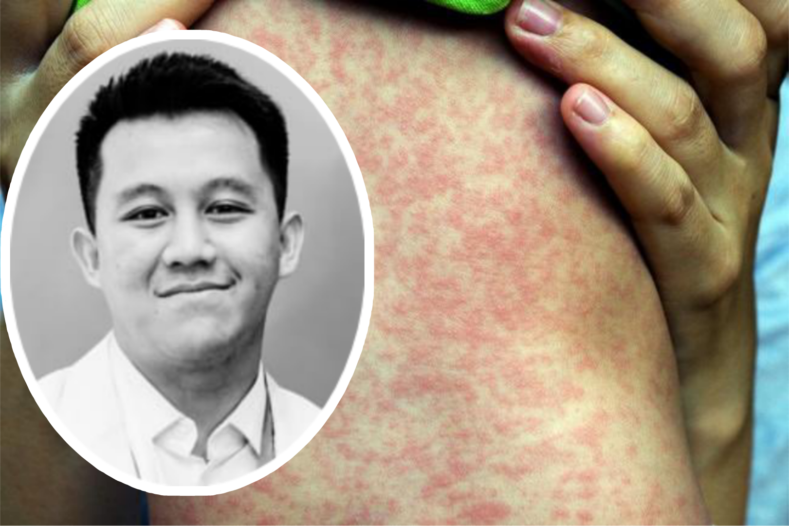 Dokter muda berinisial AMW meninggal karena campak.