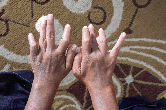 BISA DISEMBUHKAN: Penderita kusta di Palangka Raya menunjukan kondisi tangannya akibat tertular penyakit kusta, Selasa (24/1/2023). FOTO: ARIEF PRATHAMA/KALTENG POS