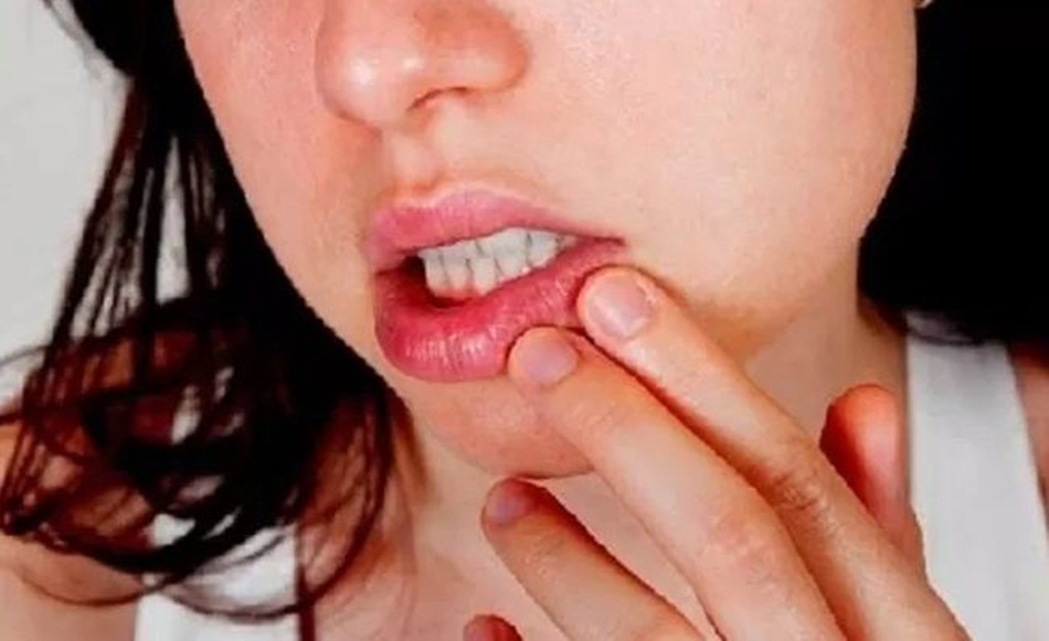 Ilustrasi bibir kering tips mengatasinya. (Pixabay)