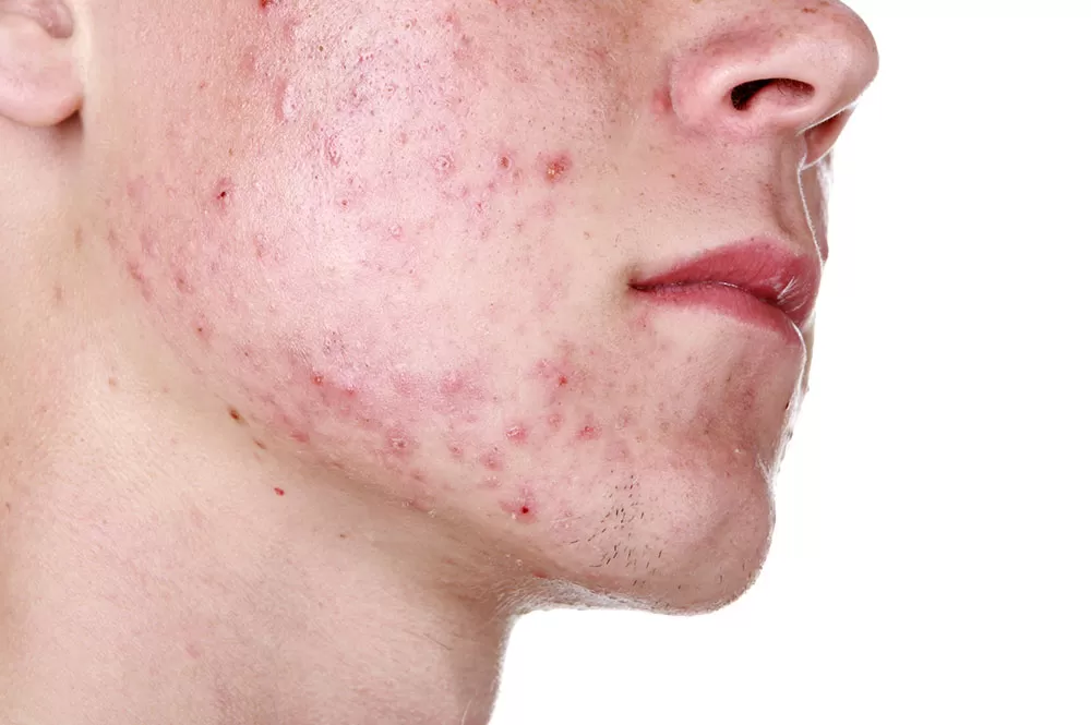 Ilustrasi jerawat pada wajah seseorang. (Dermatologistcapetown/Altaaf Parker)