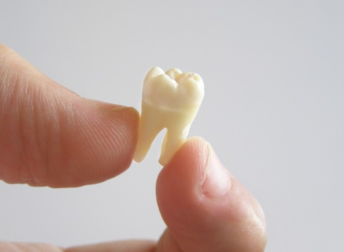 Ilustrasi : Gigi copot