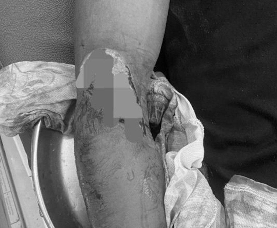 Tanpa ampun, korban dibacok hingga mengalami luka serius di tangan bagian kanan.(F:Ist)