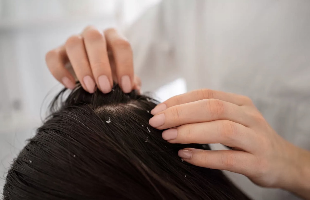 ilustrasi rambut yang penuh ketombe. Sumber foto: Freepik
