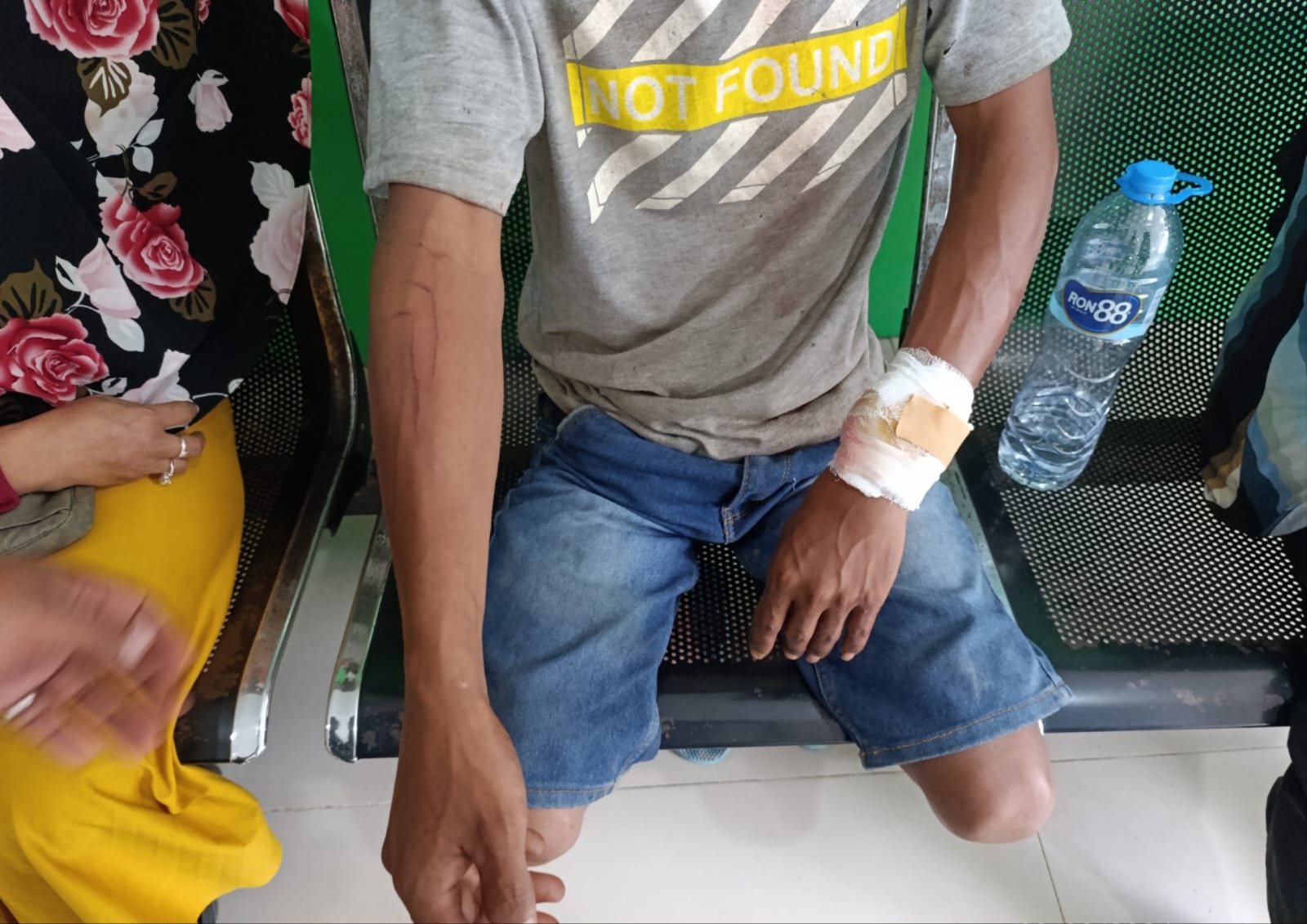 LUKA-LUKA: Hasan menunjukkan luka-luka di tangannya akibat gigitan buaya.