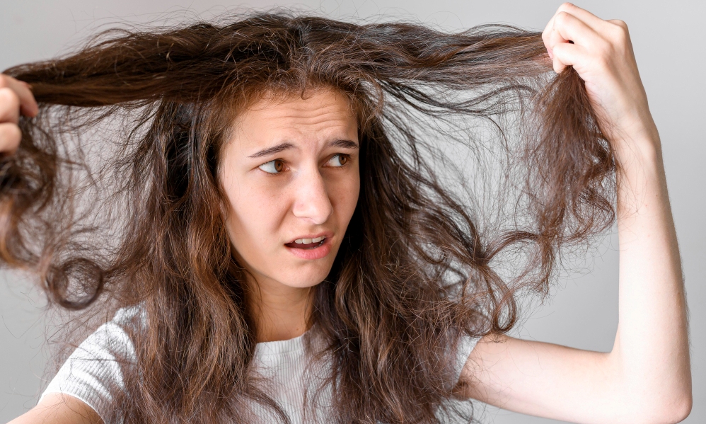 Ilustrasi rambut rontok. (FREEPIK)