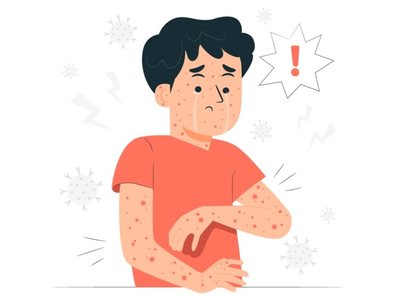 Ilustrasi MPOX.(FREEPIK)