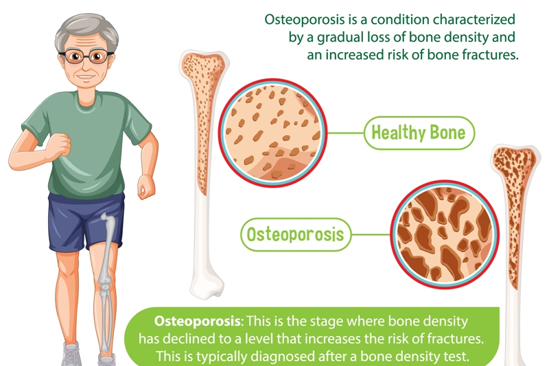 Ilustrasi osteoporosis.