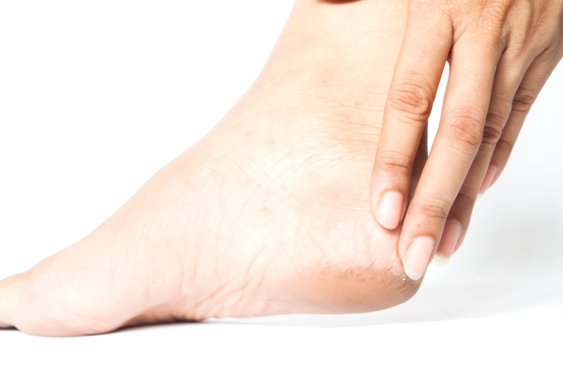 Ilusrasi tumit kering.