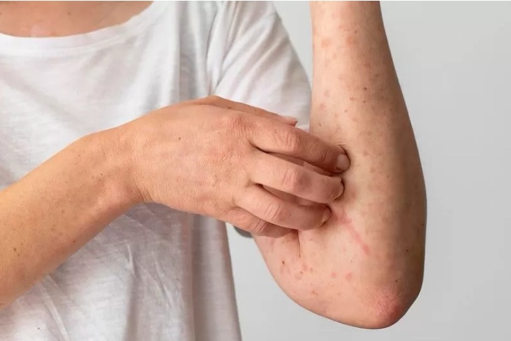 Ilustrasi orang dengan penyakit lupus.