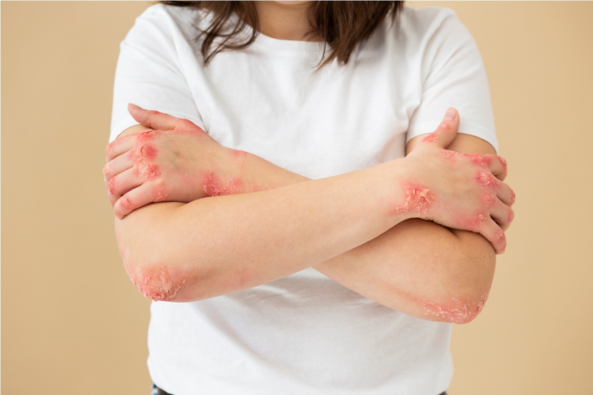 Ilustrasi seseorang mengalami iritasi dan kemerahan pada kulit tangan, yang umum terlihat pada kondisi eksim atau dermatitis.