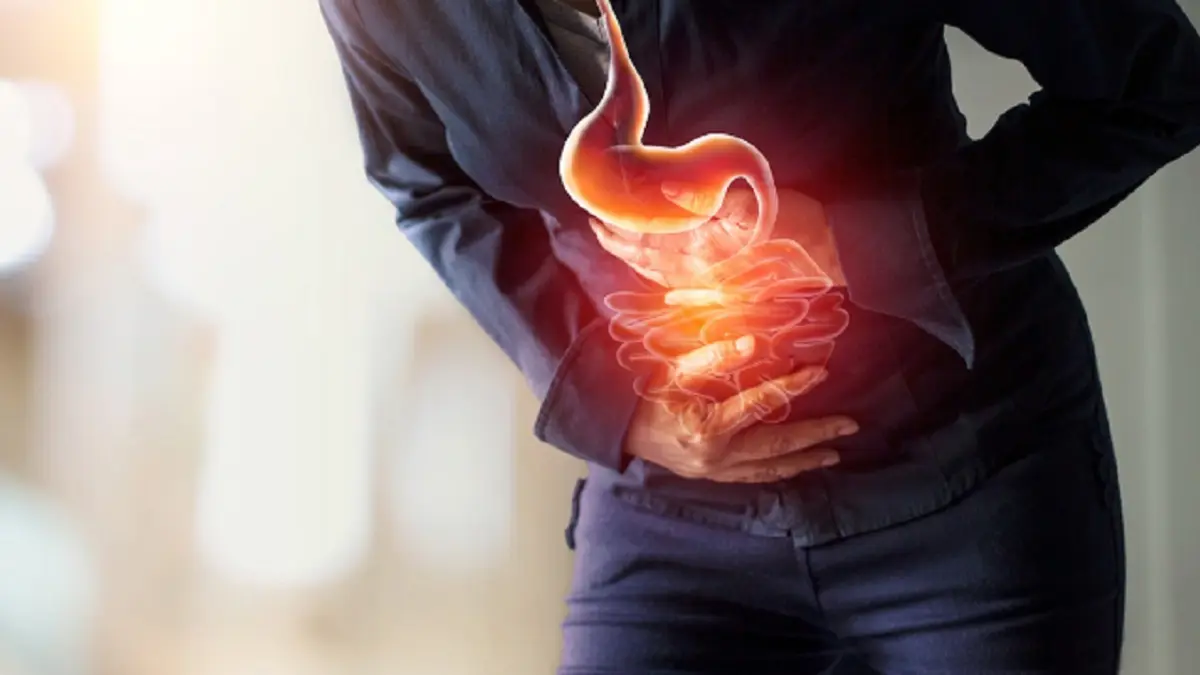 Ilustrasi GERD (JAWAPOS)