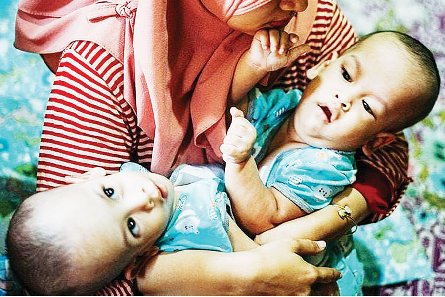 DIPISAHKAN: Bayi kembar siam Ardi dan Ardan sebelum menjalani operasi pemisahan di RSAB Harapan Kita. IST