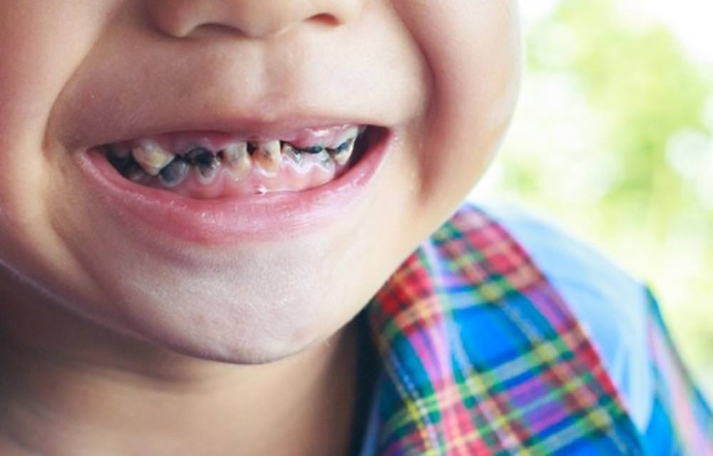 KARIES: Contoh early childhood caries gigi pada anak.  FOTO: INT