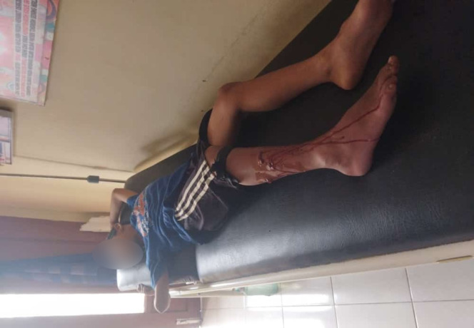 KORBAN: Seorang korban gigitan hewan penular rabies saat ditangani petugas di Puskesmas Takong. WAHYU/PONTIANAKPOST