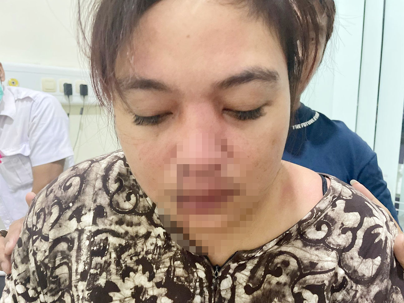 NM saat dirawat di rumah sakit karena mengalami luka di bagian hidung dan bibir.