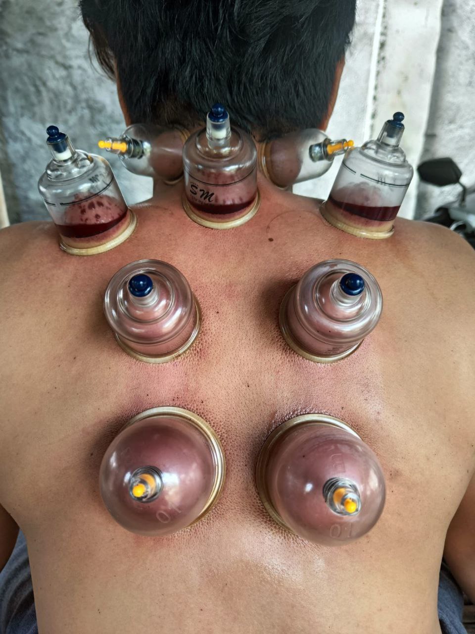 Cangkir-cangkir bekam yang terpasang di sepanjang punggung, menyedot darah hitam yang menggumpal.