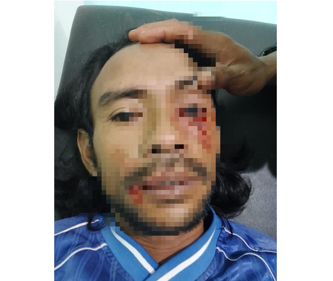 MENINGGAL DUNIA: Korban gigitan anjing suspek rabies meninggal dunia.