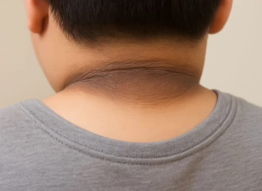 Waspada! Diabetes Tipe 2 mengintai anak-anak, orang tua harus peka dan lindungi anak-anak kita agar tidak terjangkit penyakit diabetes tersebut.
