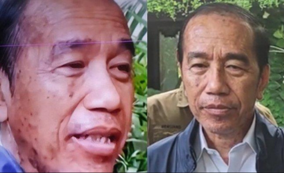 Jokowi dituding alami sindrom Steven Johnson