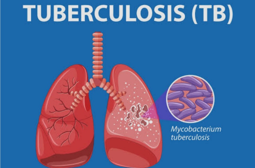 Ilustrasi penderita Tubercolosis atau TBC yang semakin banyak di Indonesia.