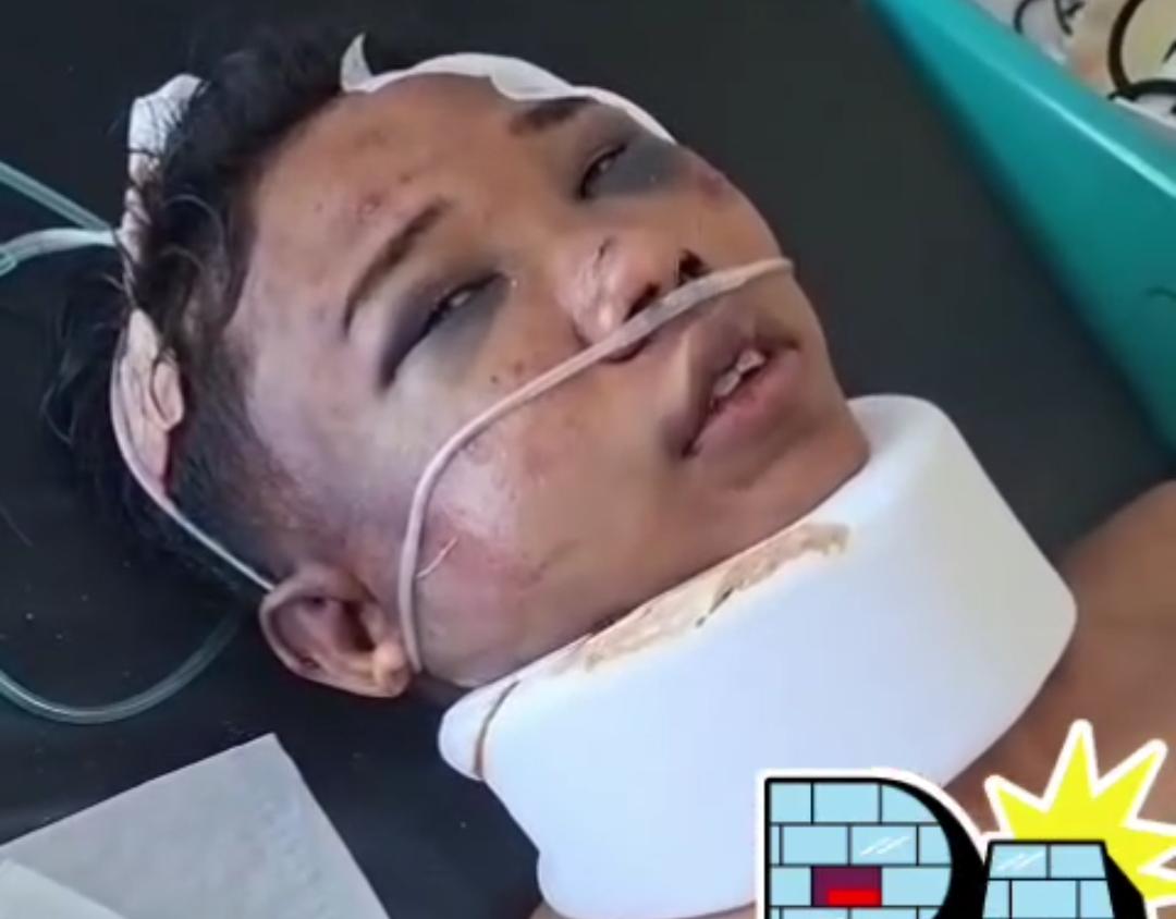 Dalam kondisi kepala penuh luka dan wajah lebam, RA, salah satu korban selamat begal Pantai Nipah, menceritakan kronologis serangan yang diterima dirinya dan MVPN dari orang yang tak dikenal.