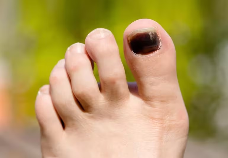 Ilustrasi kuku kaki pelari. (health.clevelandclinic.org)