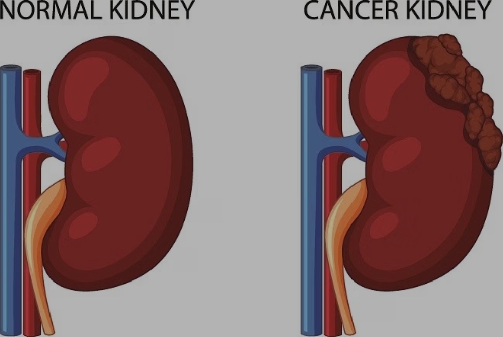 Perbedaan ginjal normal dan telah kena kanker. (Alodokter)