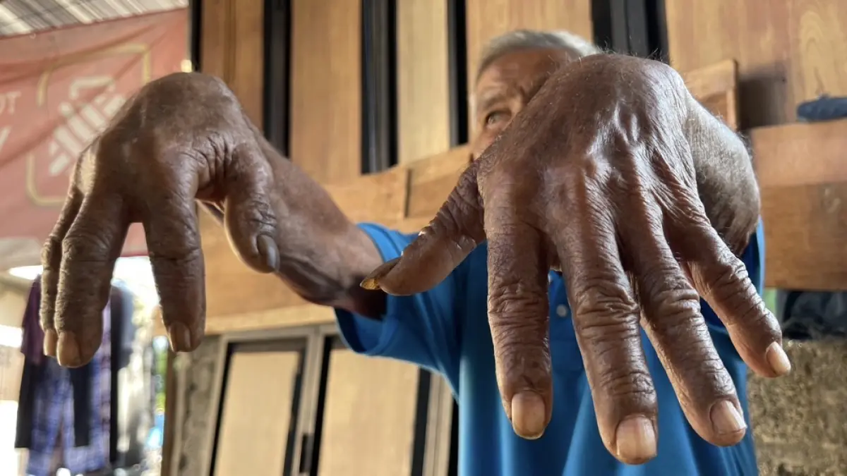 BERTAHAN DENGAN PENYAKIT: Raham, warga Bintaro Jaya, Ampenan, menunjukkan kondisi tangan yang membengkak akibat penyakit yang dideritanya selama belasan tahun.